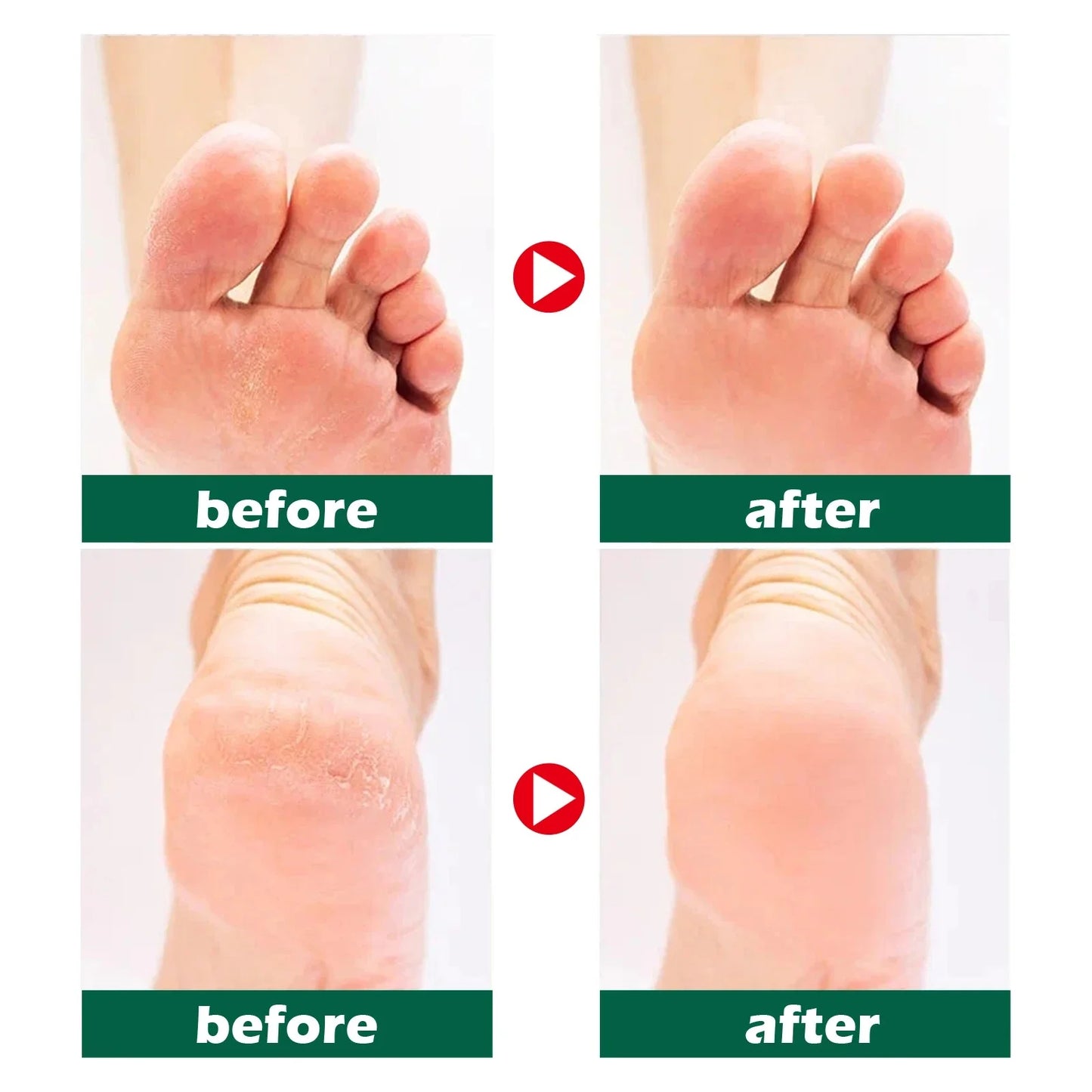 Cream for Dry Cracked Feet